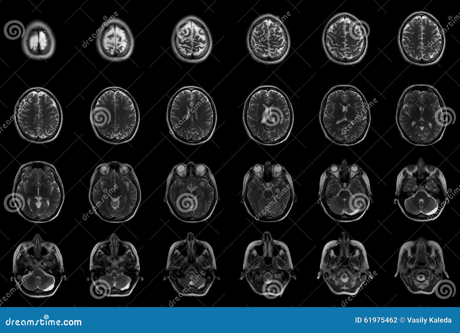 Mänsklig hjärna på MRI-bildläsningar. Transversal- sektions- nivåer av det mänskliga huvudet på MRI avläser i en patient med intracranial blödning