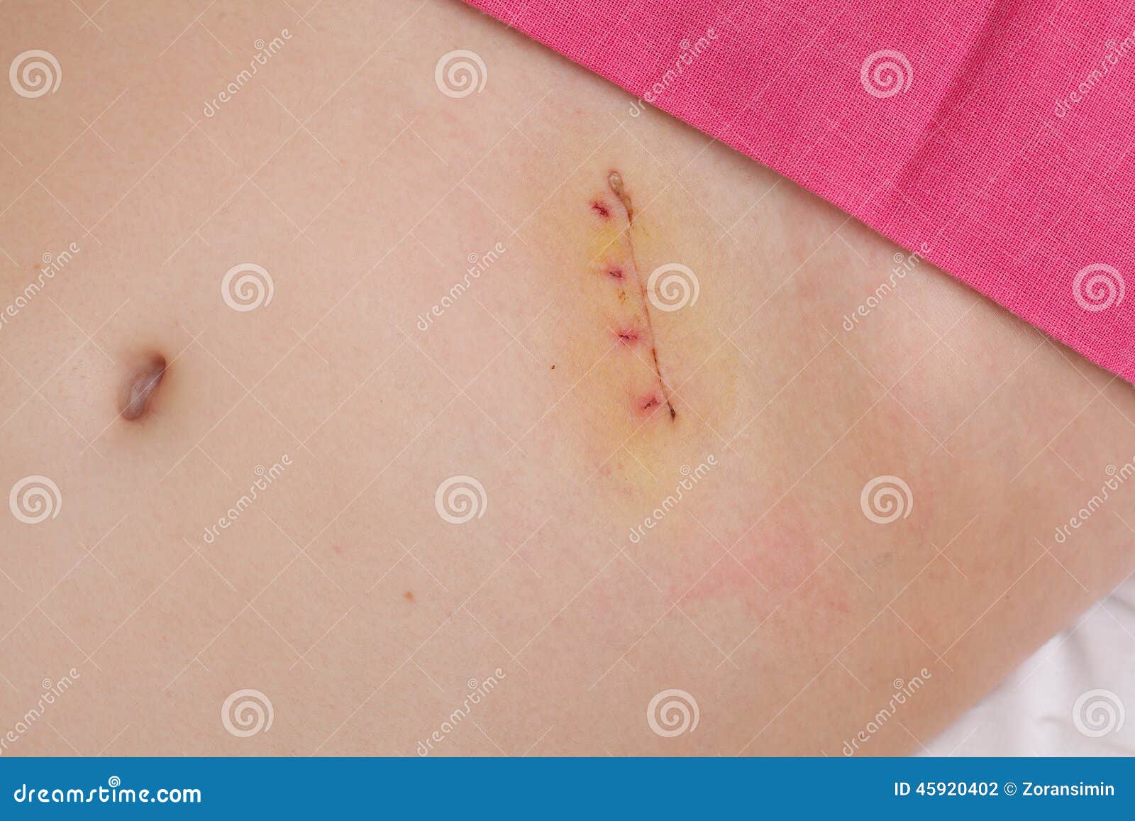 Médecine, Cicatrice De Chirurgie D'appendectomy Photo stock Image du