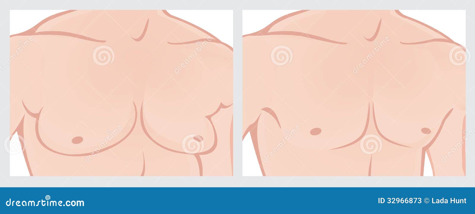 Męskiej klatki piersiowej redukcja. Ilustracja męska klatka piersiowa przed i po chirurgią plastyczną