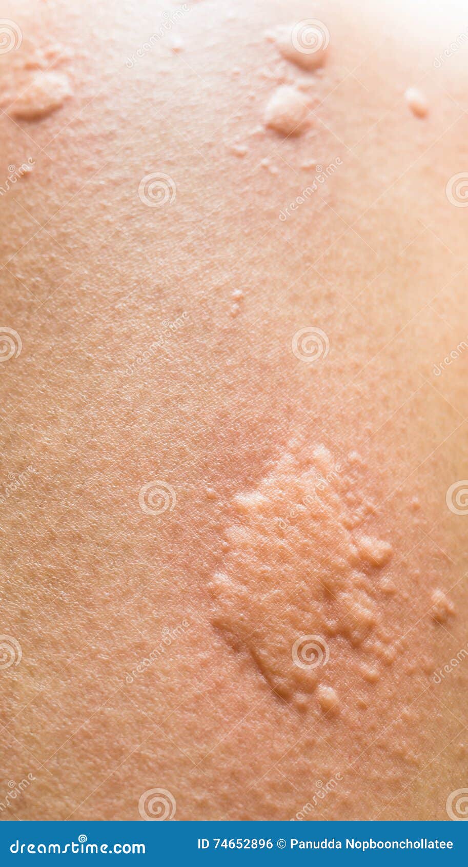 Nahaufnahme Auf Symptomen Des Juckenden Urticaria Stockfoto - Bild Von