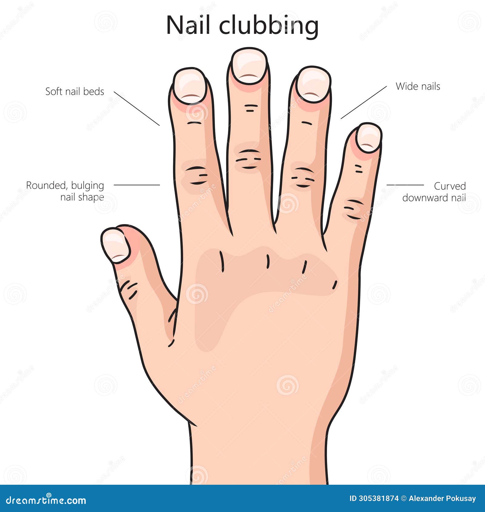 Revive Nail Studio - Did you know that nail clubbing can be a result of  long-term smoking habits? 