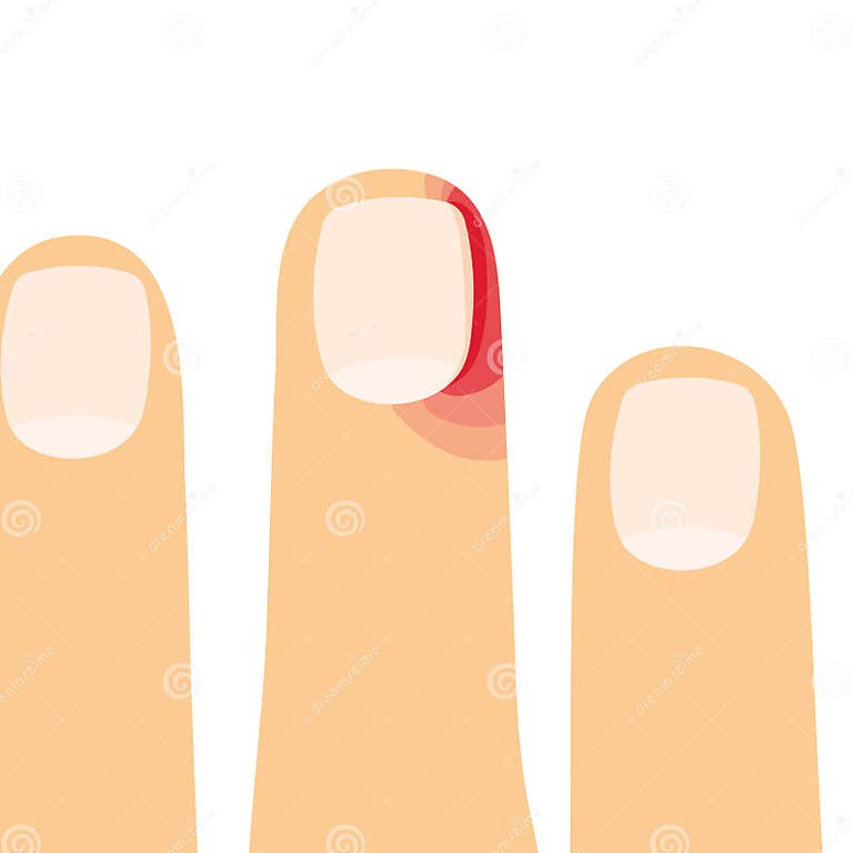 Nail Disease Paronychia, Inflammation of the Skin Around the Nail Stock ...