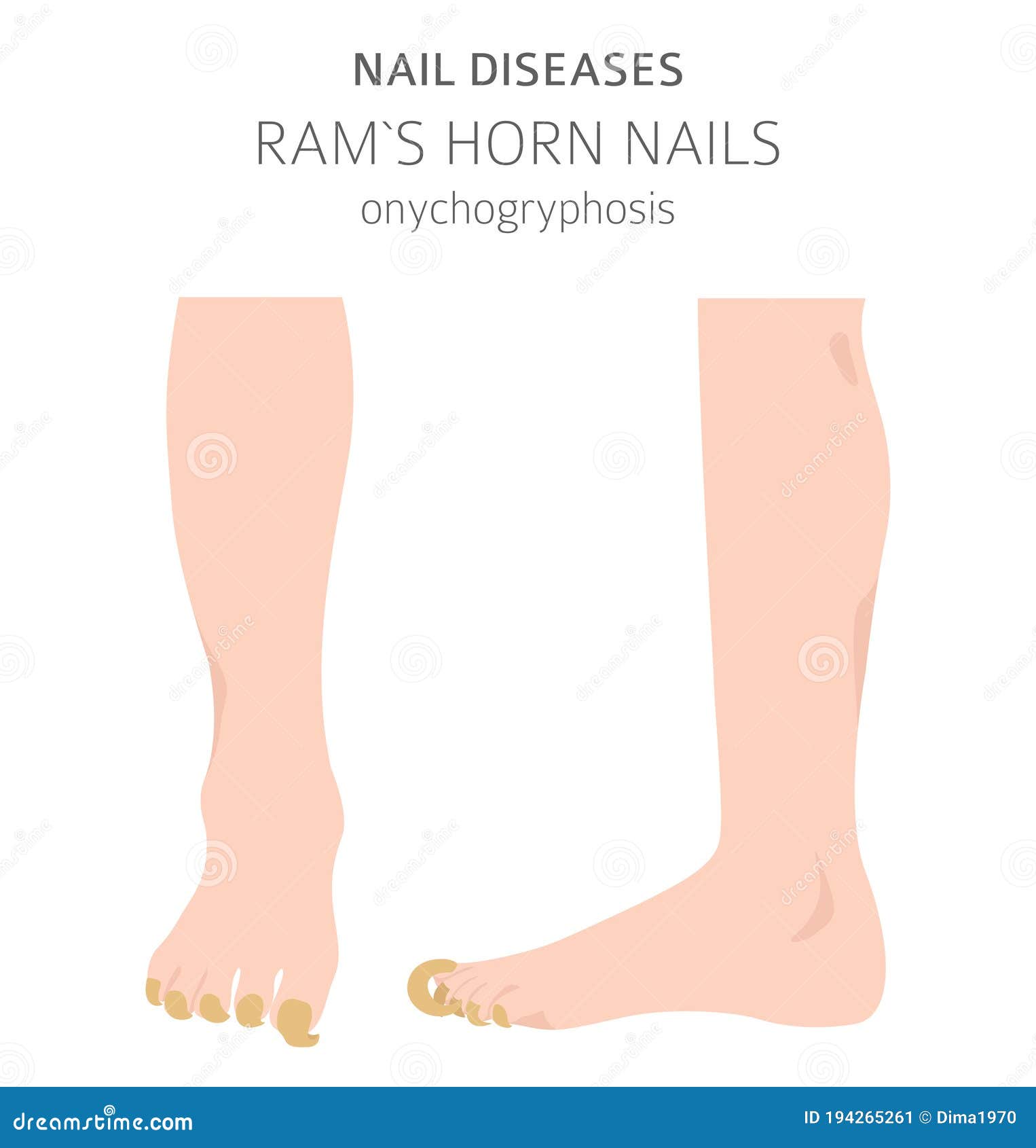 Nail Diseases. Onychomycosis, Nail Fungal Infection Causes, Treatment Icon  Set Stock Vector - Illustration of fingers, chart: 194265241