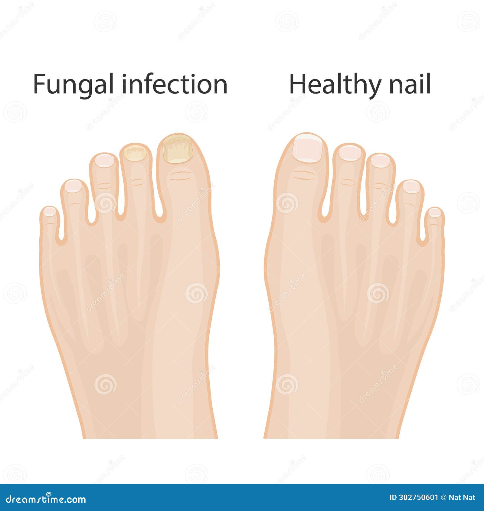 What you need to know about pseudomonas nail infections aka 