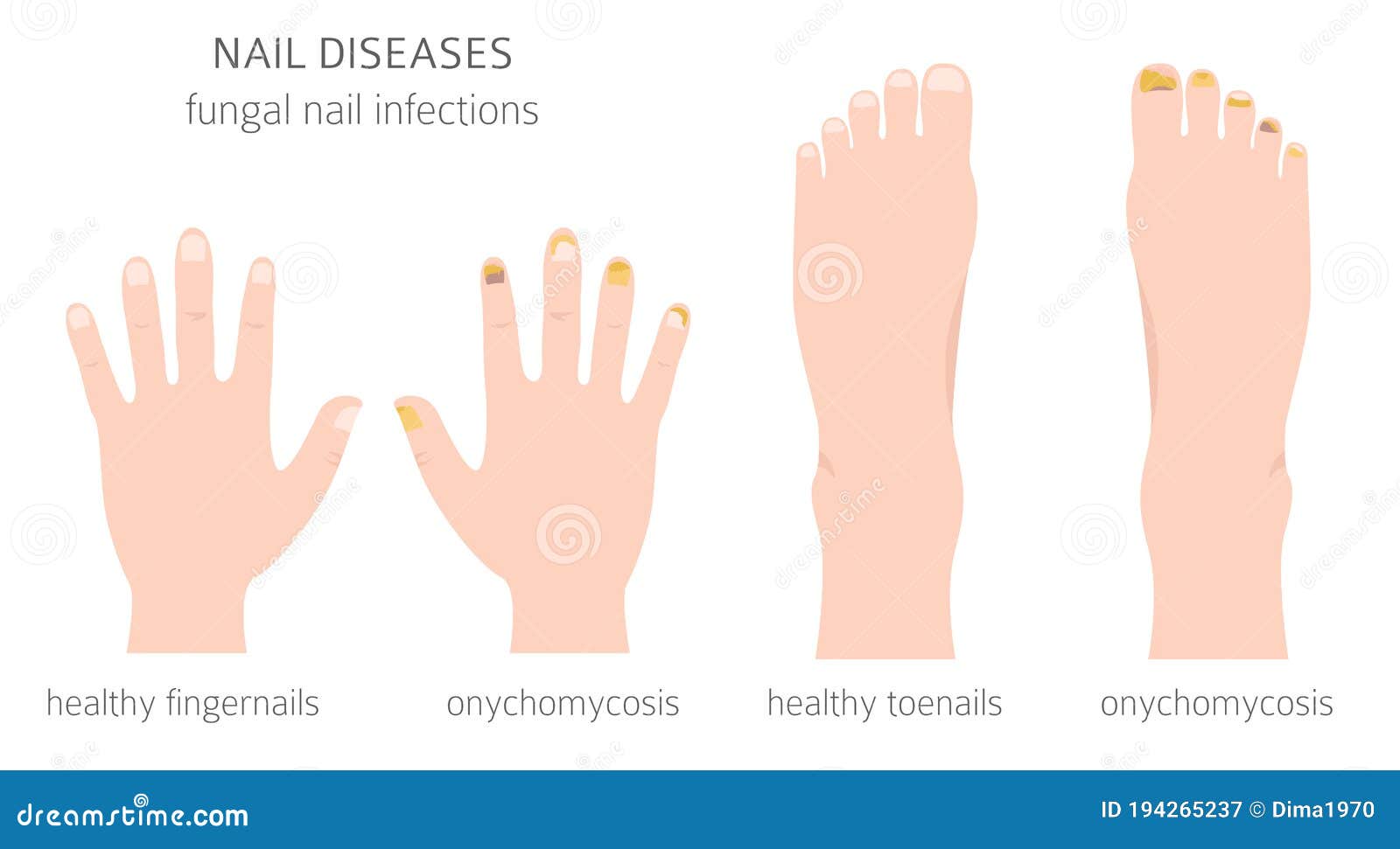 Onychomycosis: fungus and nail infection | Almirall