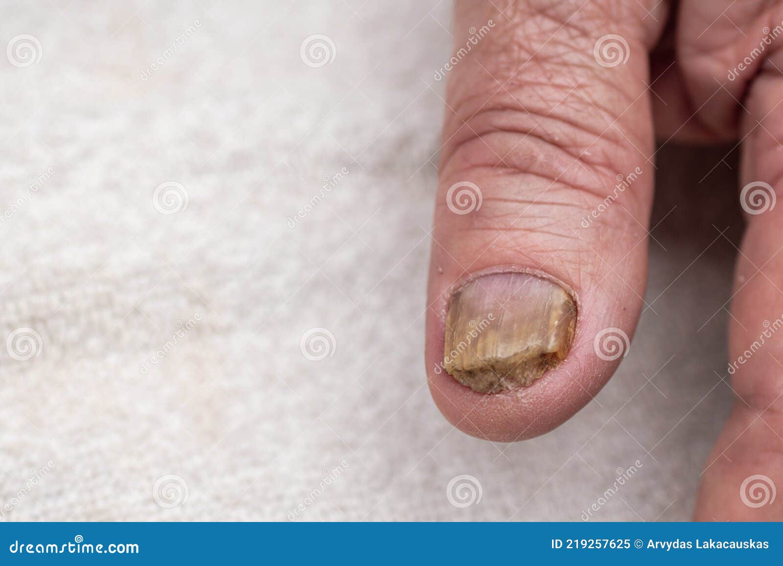 Big Close Fungus Infection Nails Hand Finger Onychomycosis Fungal Infection  Stock Photo by ©n.nonthamand.gmail.com 193497866