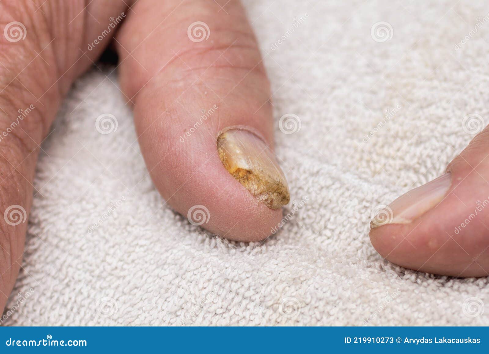 Pro Anti Fungal Nail Treatment Repair Finger Toe Care Nail Fungus Liquid |  eBay