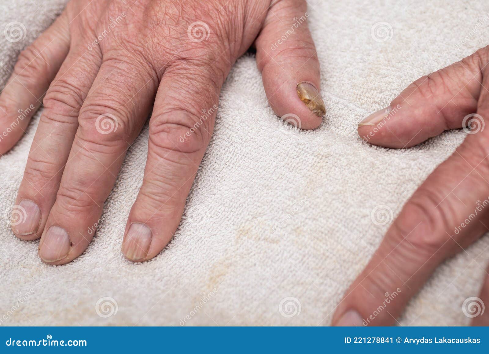 Close up of fungus nail infection. Fungal infection on nails hand, finger  with onychomycosis, damage on human hand on gray concrete wall background.  Disease and Symptom concept. Stock Photo | Adobe Stock