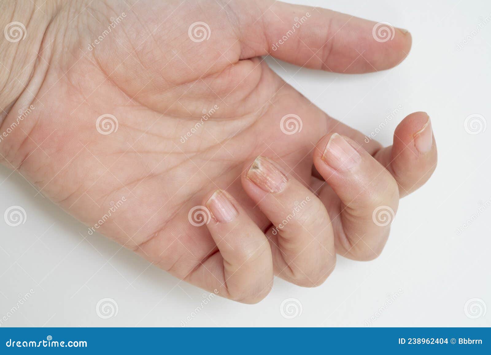 Closeup Hand of a Woman with Nail Fungus Stock Image - Image of health,  dirty: 261597461