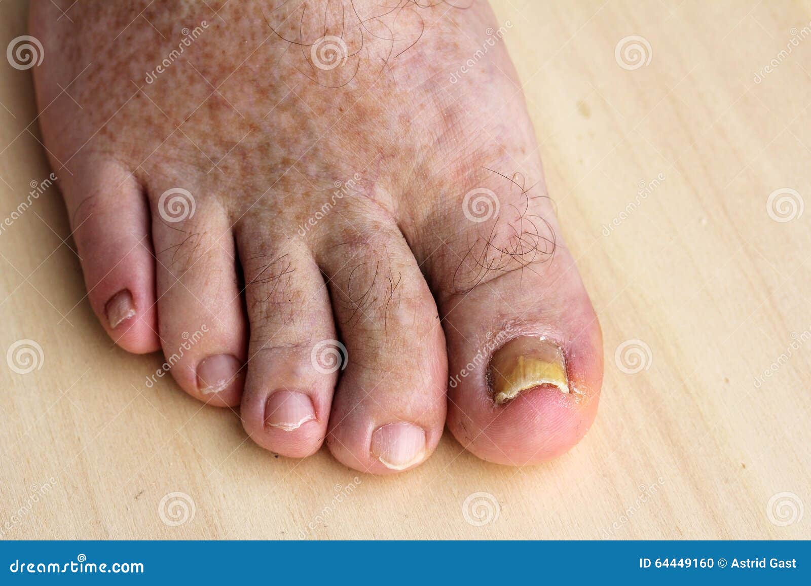 gomba skin hands nail foot)