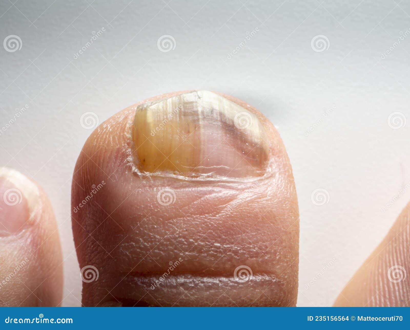 Nail Infections Caused by Fungi Such As: Onychomycosis Also Known