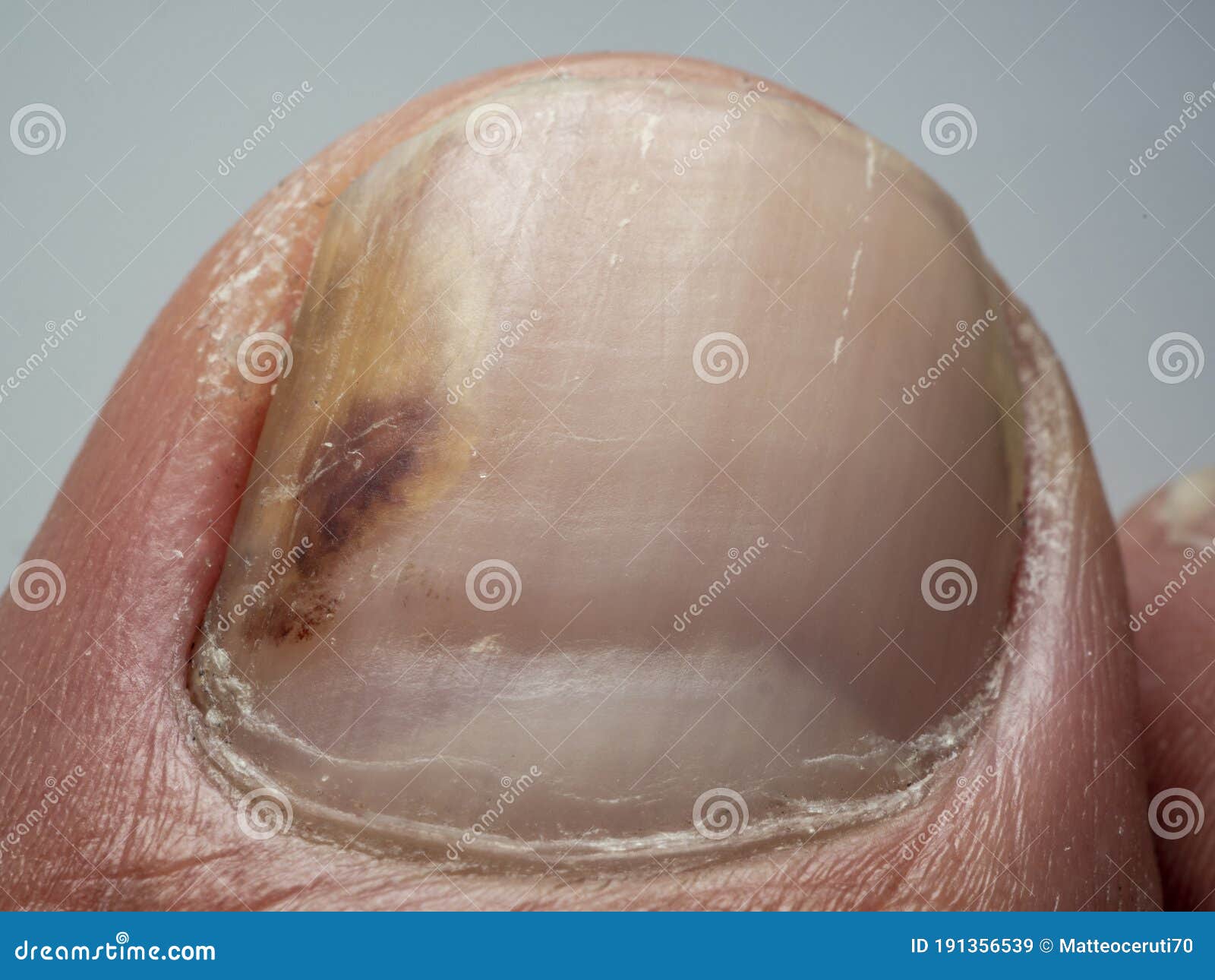 Closeup Onychomycosis Tinea Unguium Fungal Infection Stock Photo