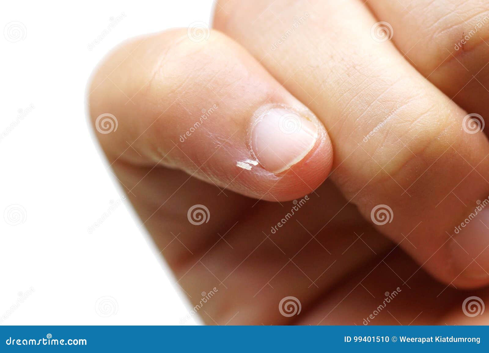 Nail skin peeling stock photo. Image of hurt, hand, peeling - 99401510