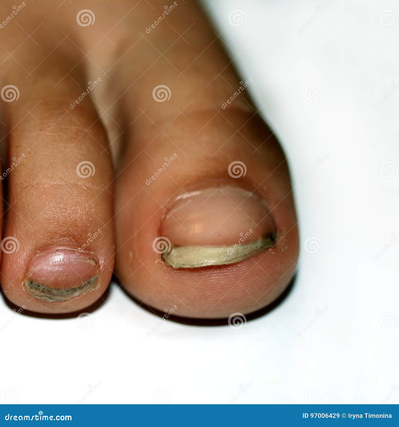 Nails on the Feet, Dirty. Ingrown Toenails. Black Dirty Fingernails. Stock  Image - Image of chinese, deformed: 97006429