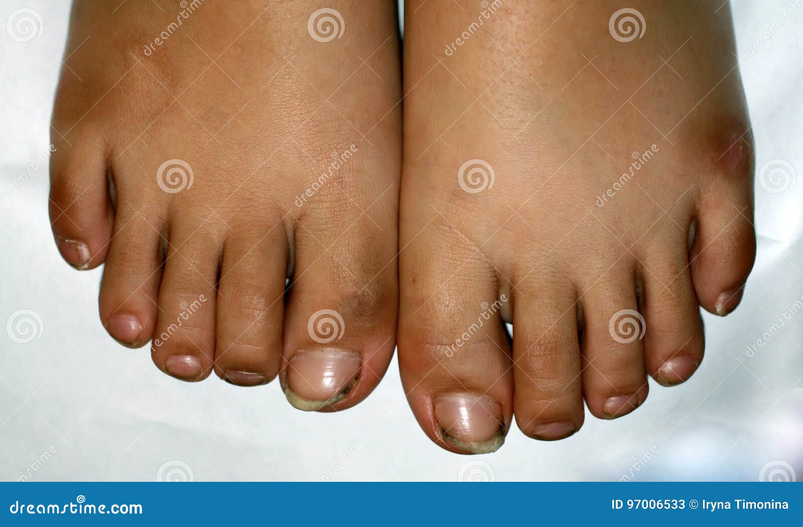 Nails on the Feet, Dirty. Ingrown Toenails. Black Dirty Fingernails. Stock  Image - Image of legal, finger: 97006533