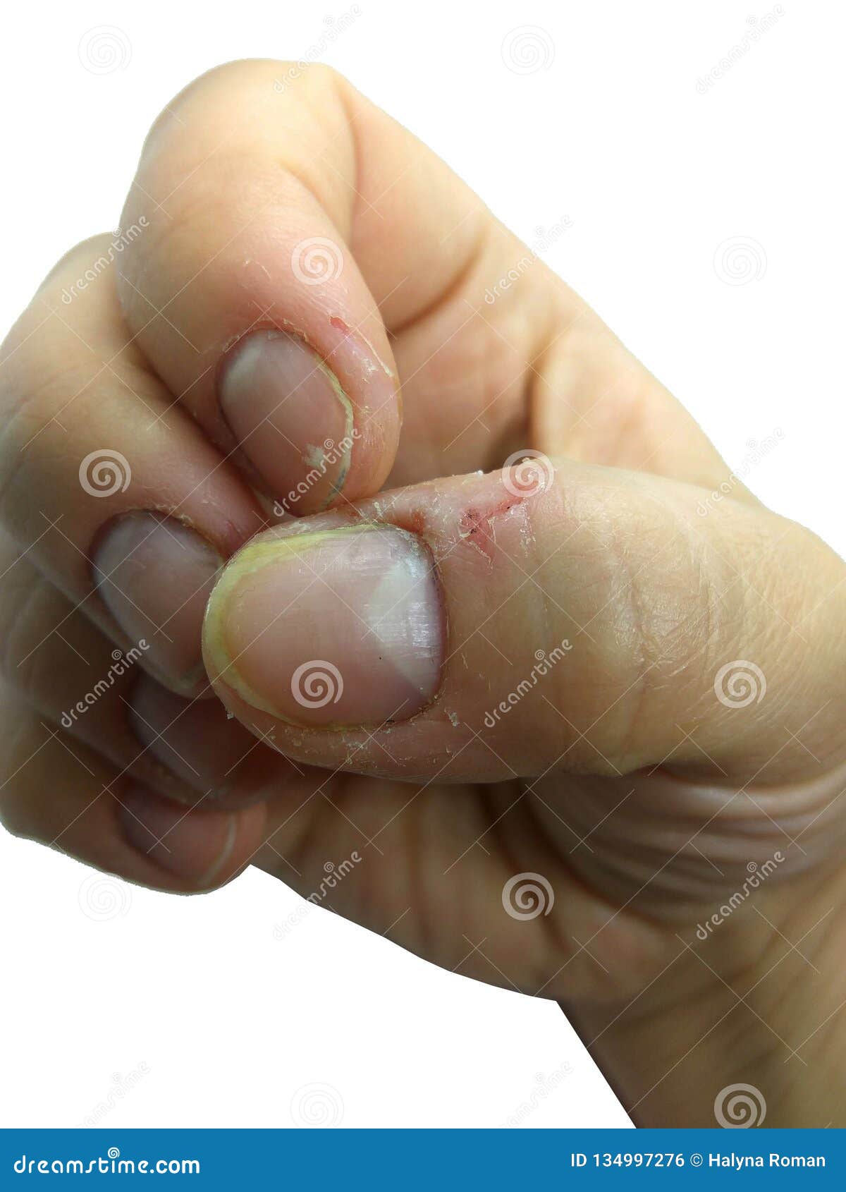 Damaged Nervous Nails, Biting Nails on Fingers Stock Photo - Image of finger, fingernail: 134997276 Damaged Nervous Nails, Biting Nails on Fingers Stock Photo - Image of finger, fingernail: 134997276