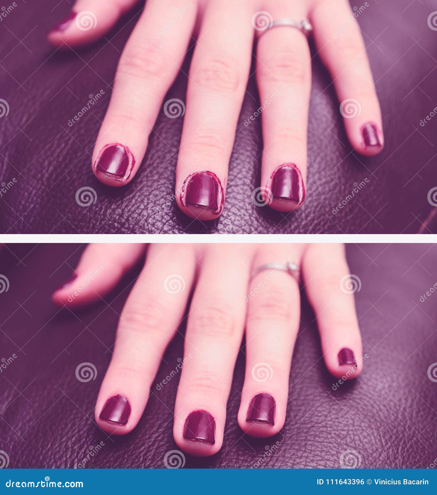Before and after of the Nails before Removing the Excess of Pain Stock Photo Image of care