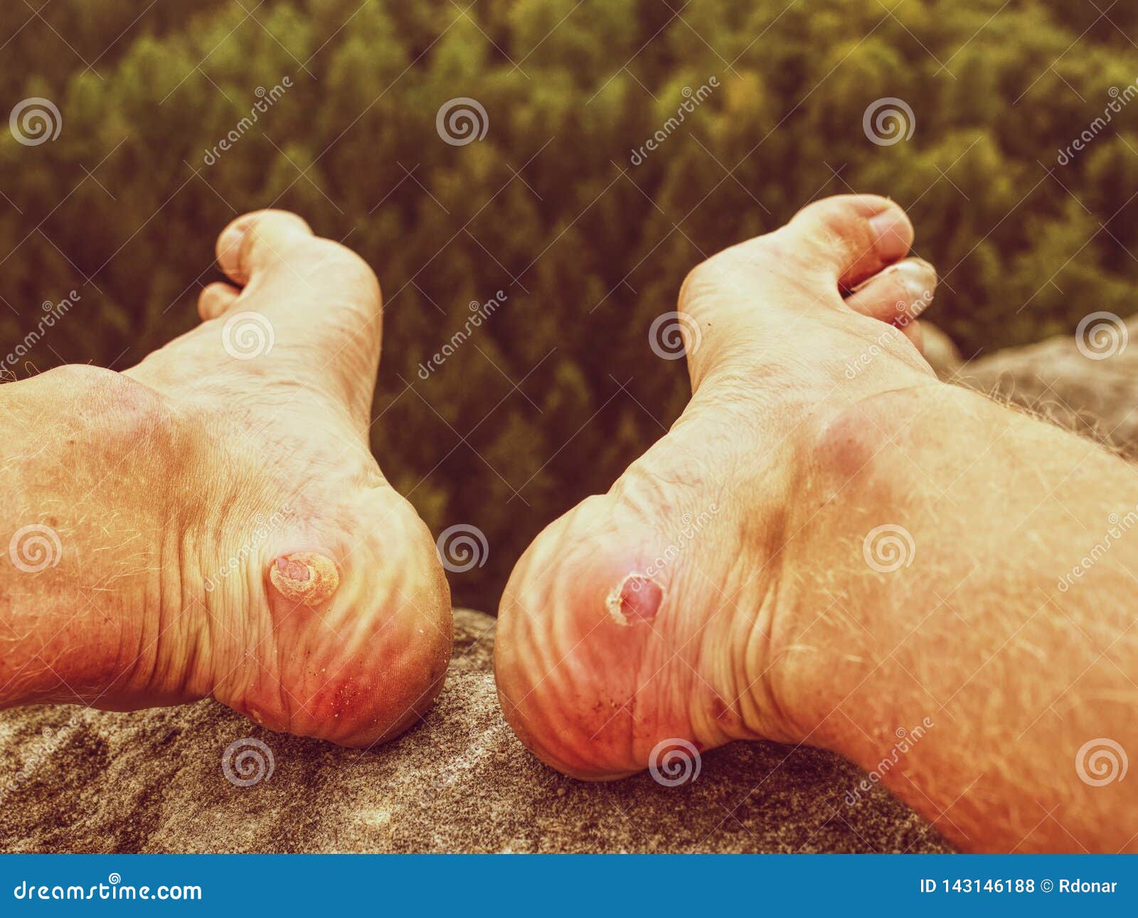 1600px x 1290px - Naked Foot With Painful Heel Wound In Nature. Man Feet Stock ...
