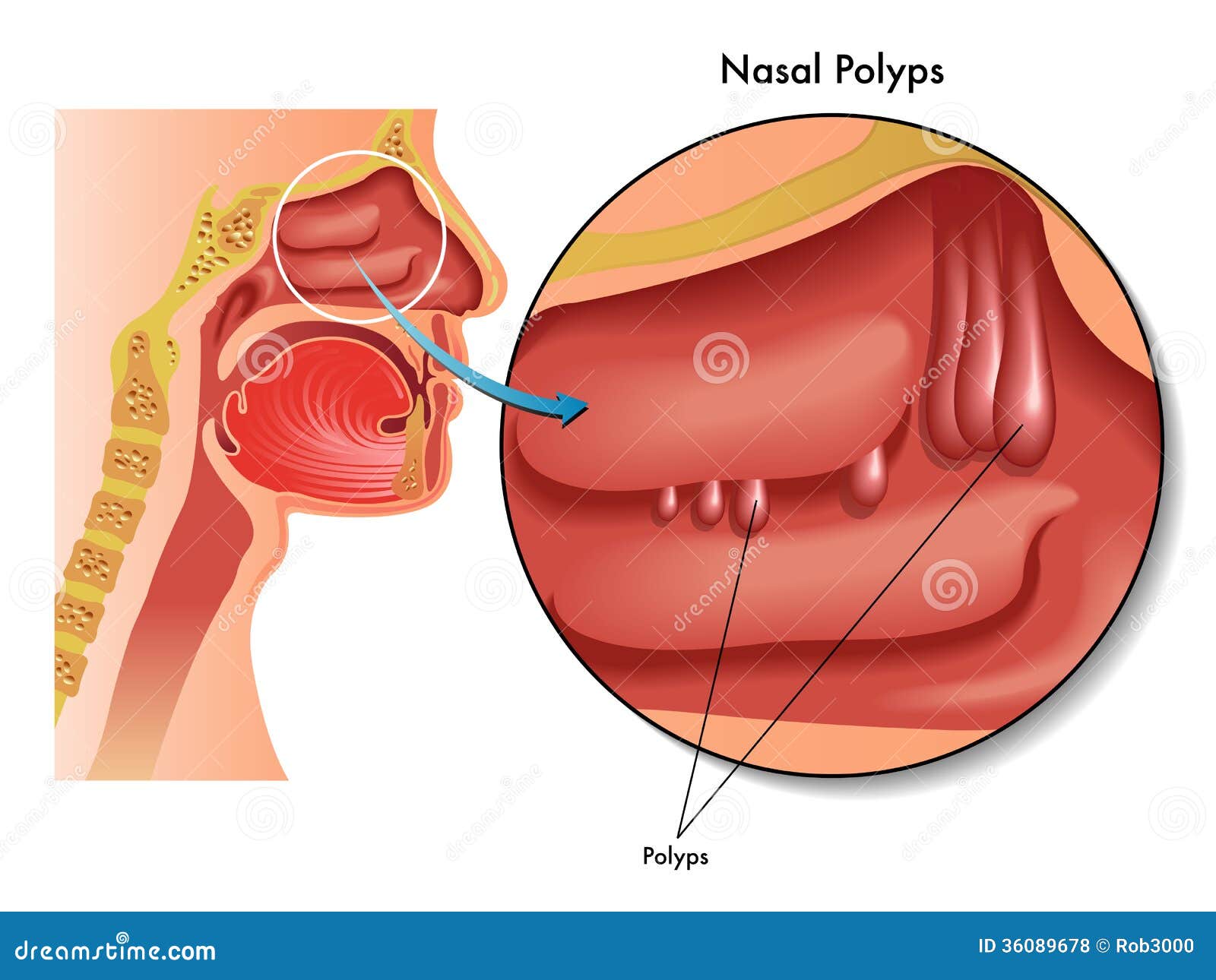 nasal polyps