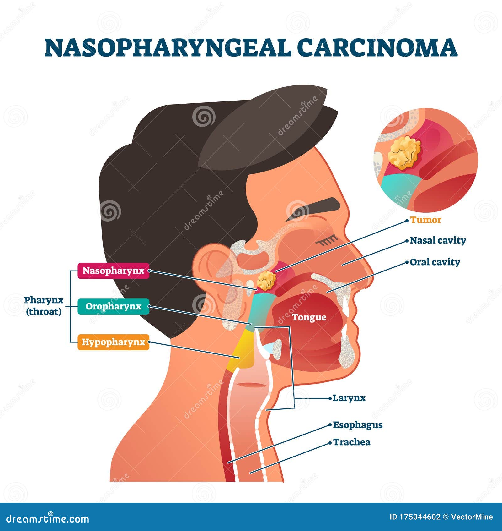 nasopharyngeal carcinoma tumor,  