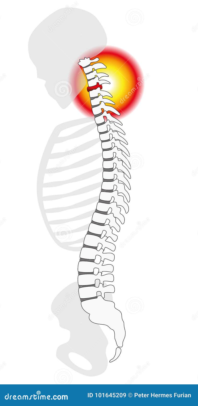 neck pain cervical vertebrae spinal disc prolapse