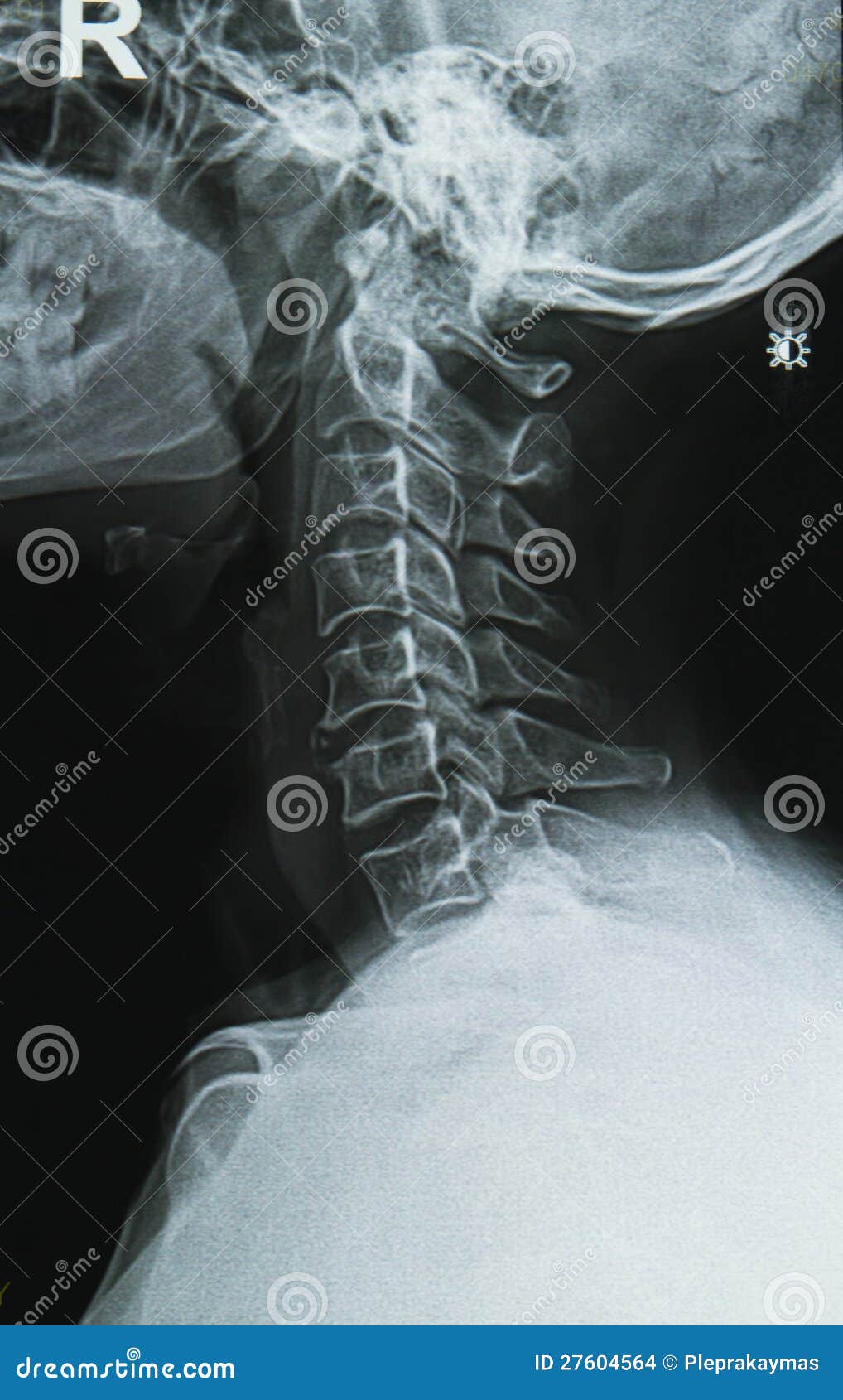 Neck xray image stock photo. Image of patient, person 27604564