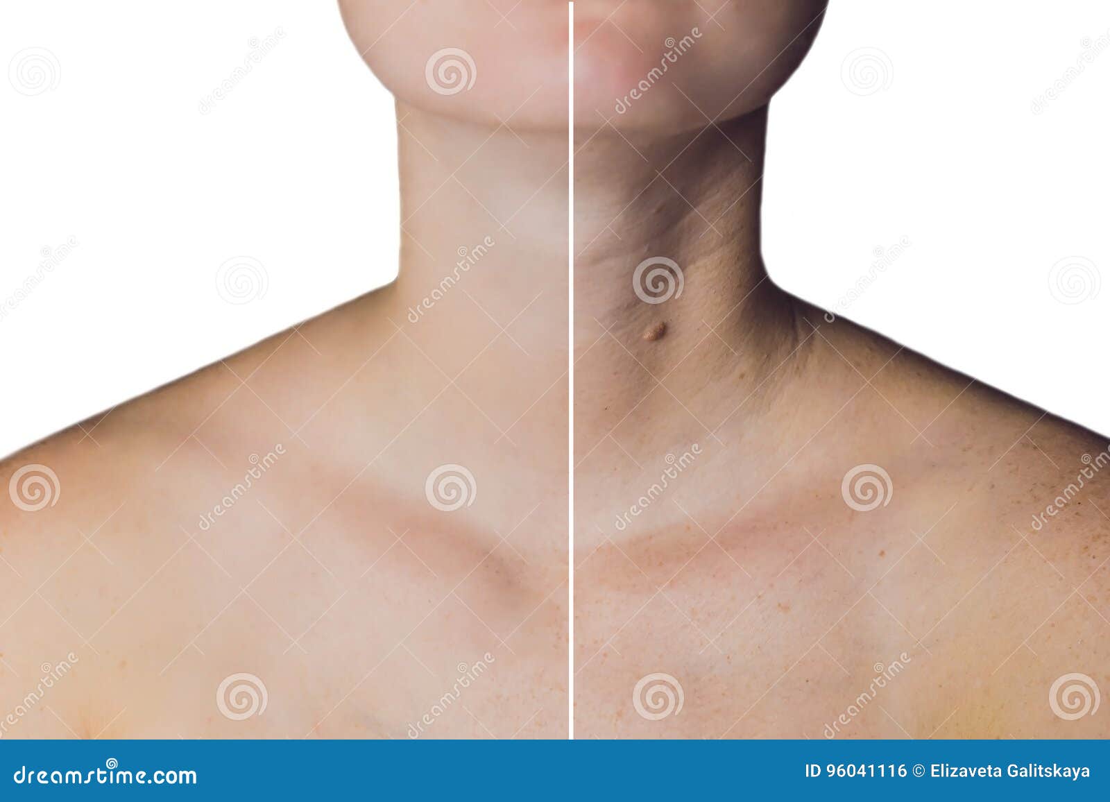 neck of a woman before and after botox. young and old neck