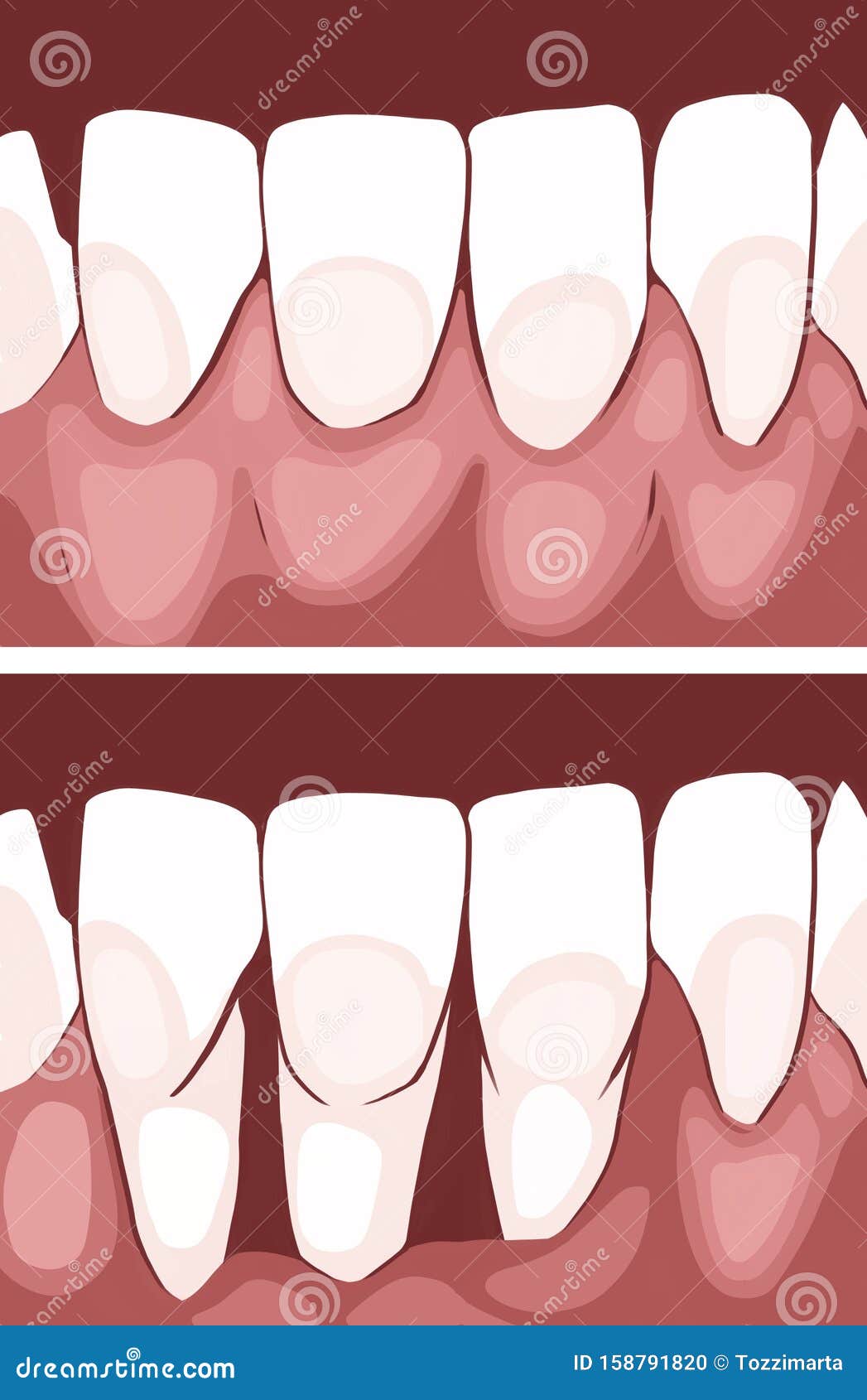 Necrotizing Ulcerative Gingivitis is a Periodontal Diseases Stock