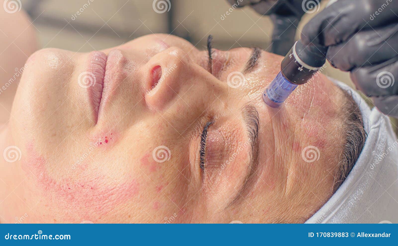Needle Mesotherapy Treatment on a Woman Face Stock Image Image of acid, microneedling 170839883