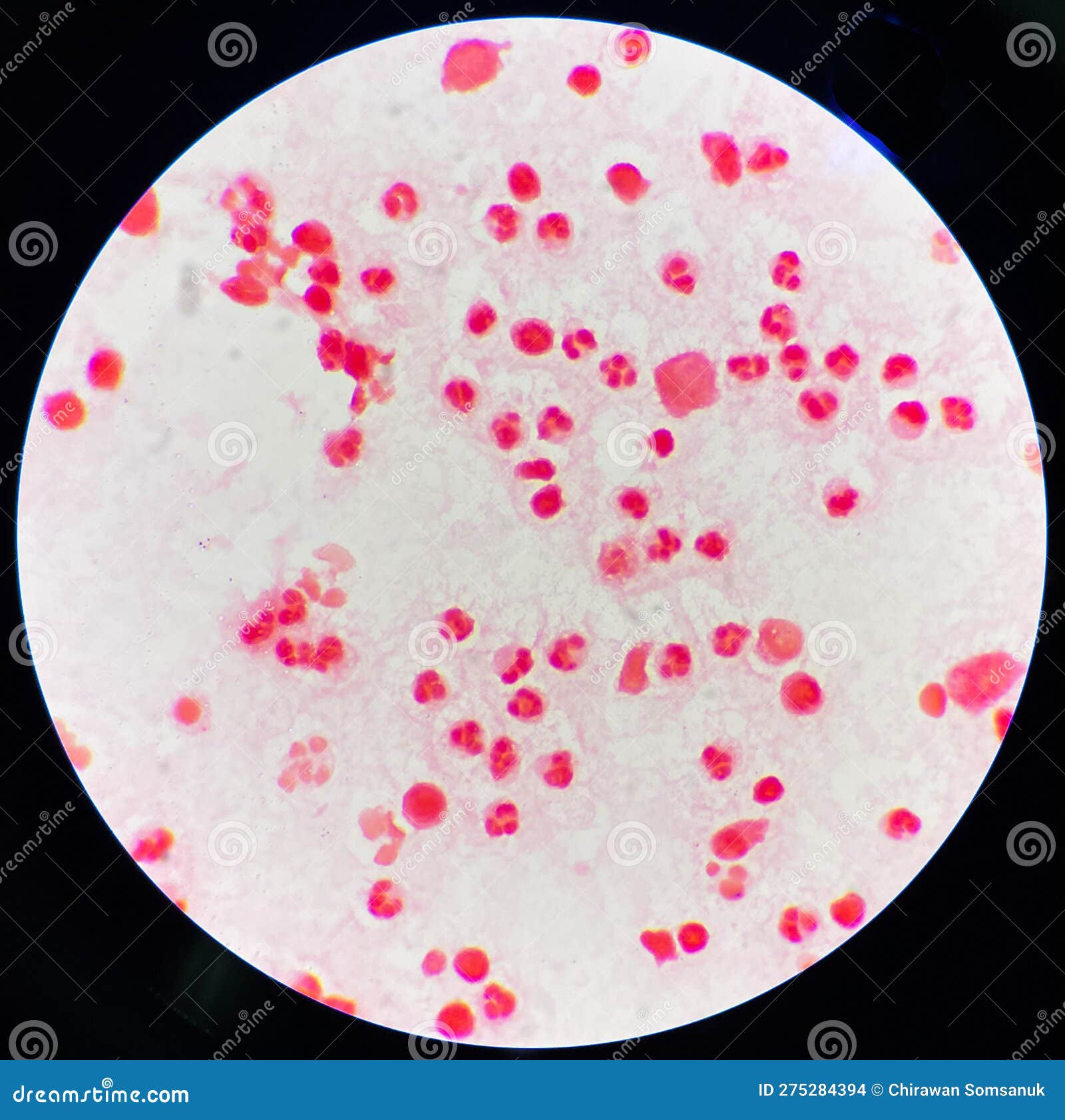 Neutrophil in Synovial Fluid Inframatory Cells Stock Photo Image of