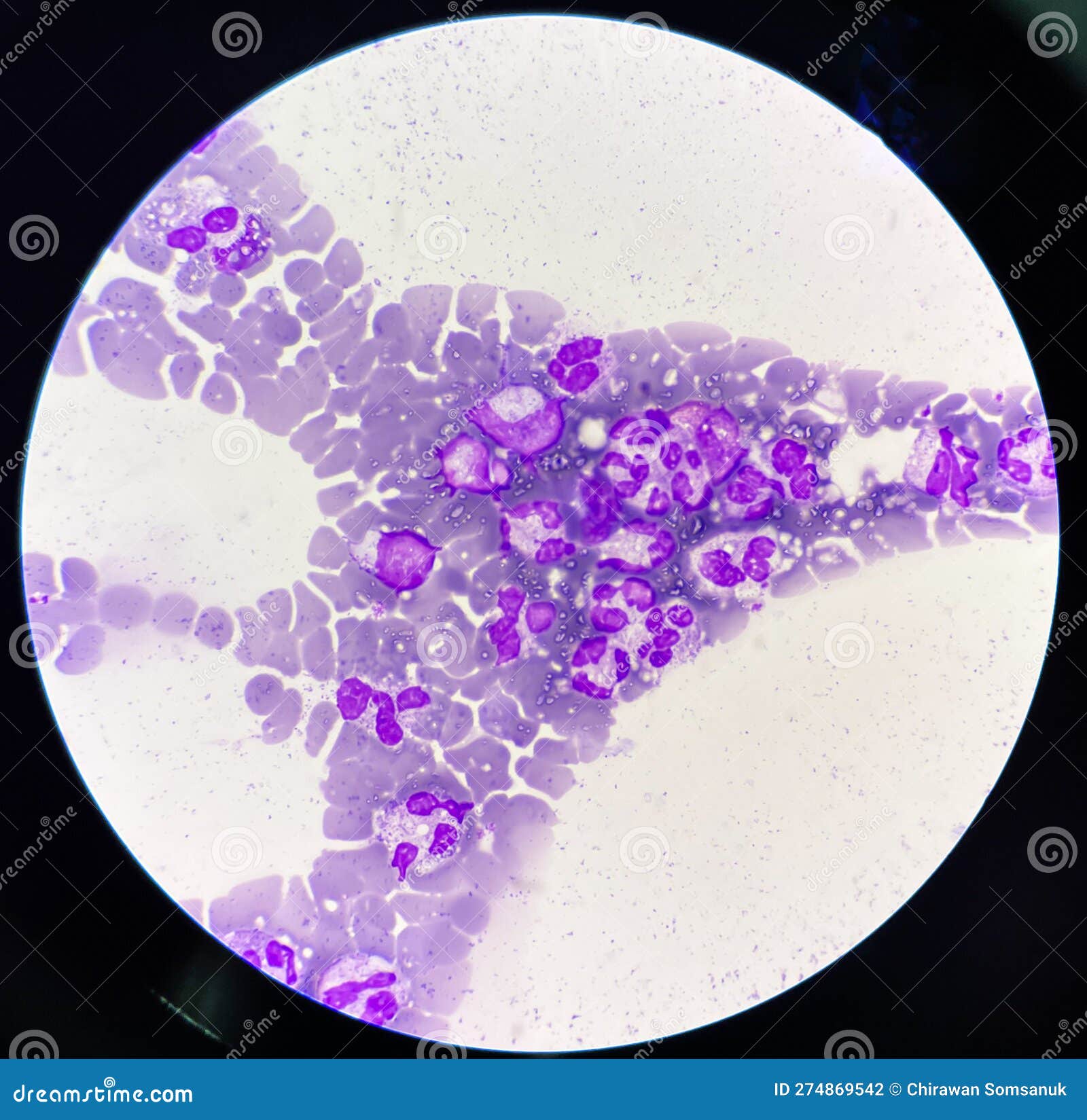 neutrophil with toxic granulation and vacuole