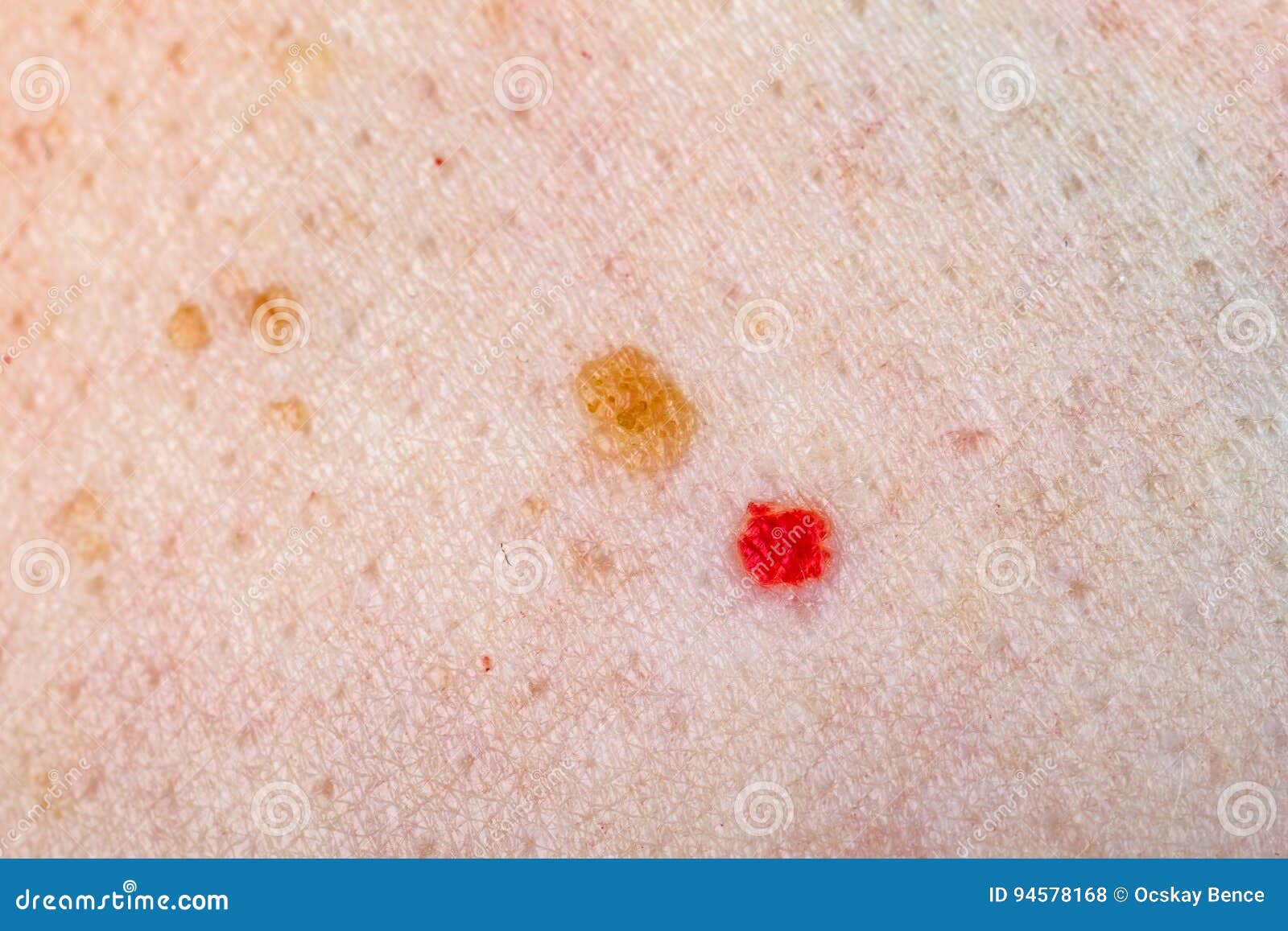Cherry Angioma On Human Skin Royalty-Free Stock Image | CartoonDealer