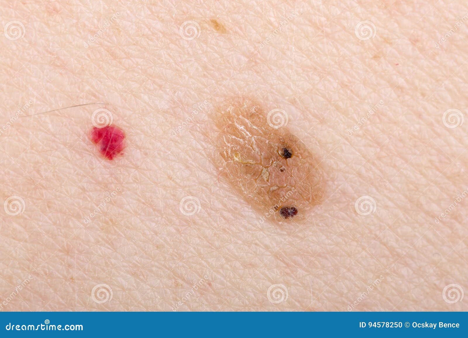 Cherry Angioma On Human Skin Royalty-Free Stock Photography