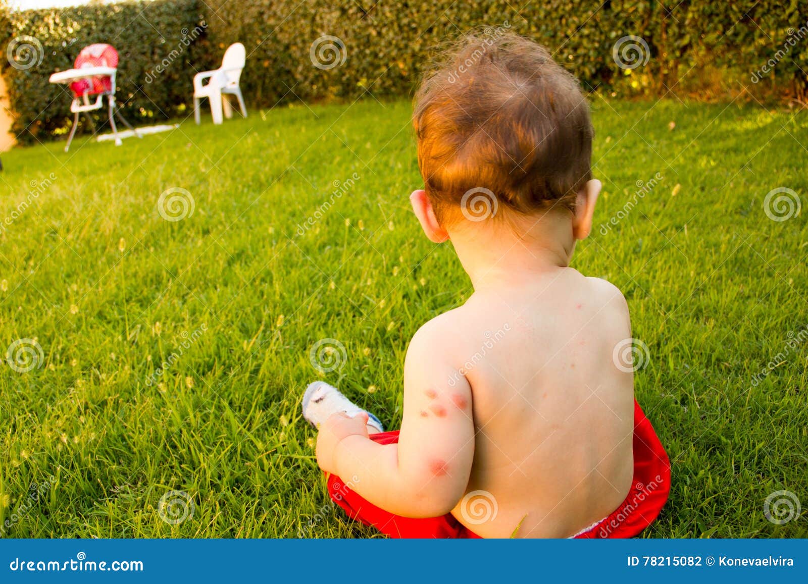 New Born with Multiple Mosquito Bites. Allergy To Insect Bites Stock