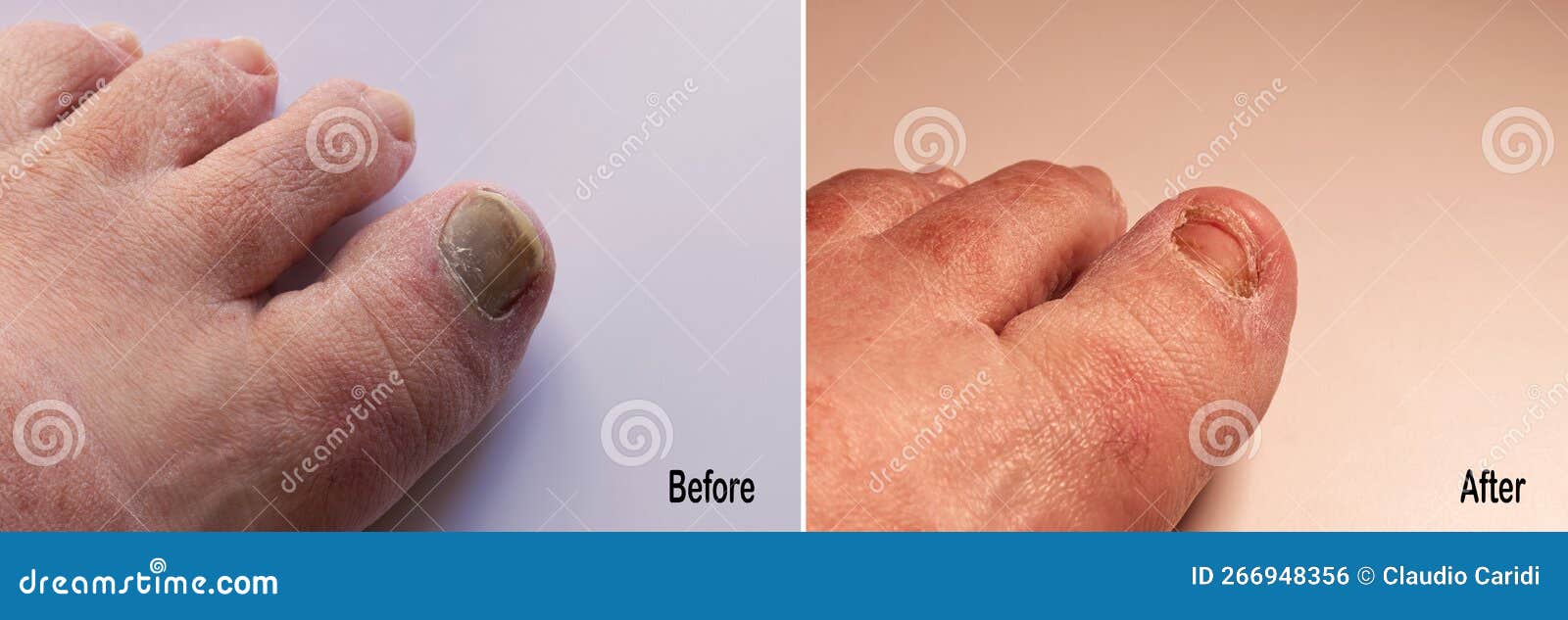 New Healthy Toenail in the Process of Regrowing after Trauma. before