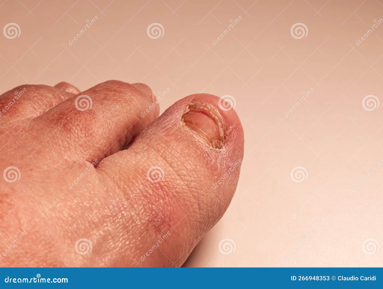 New Toenail in the Process of Regrowing after Trauma Stock Image
