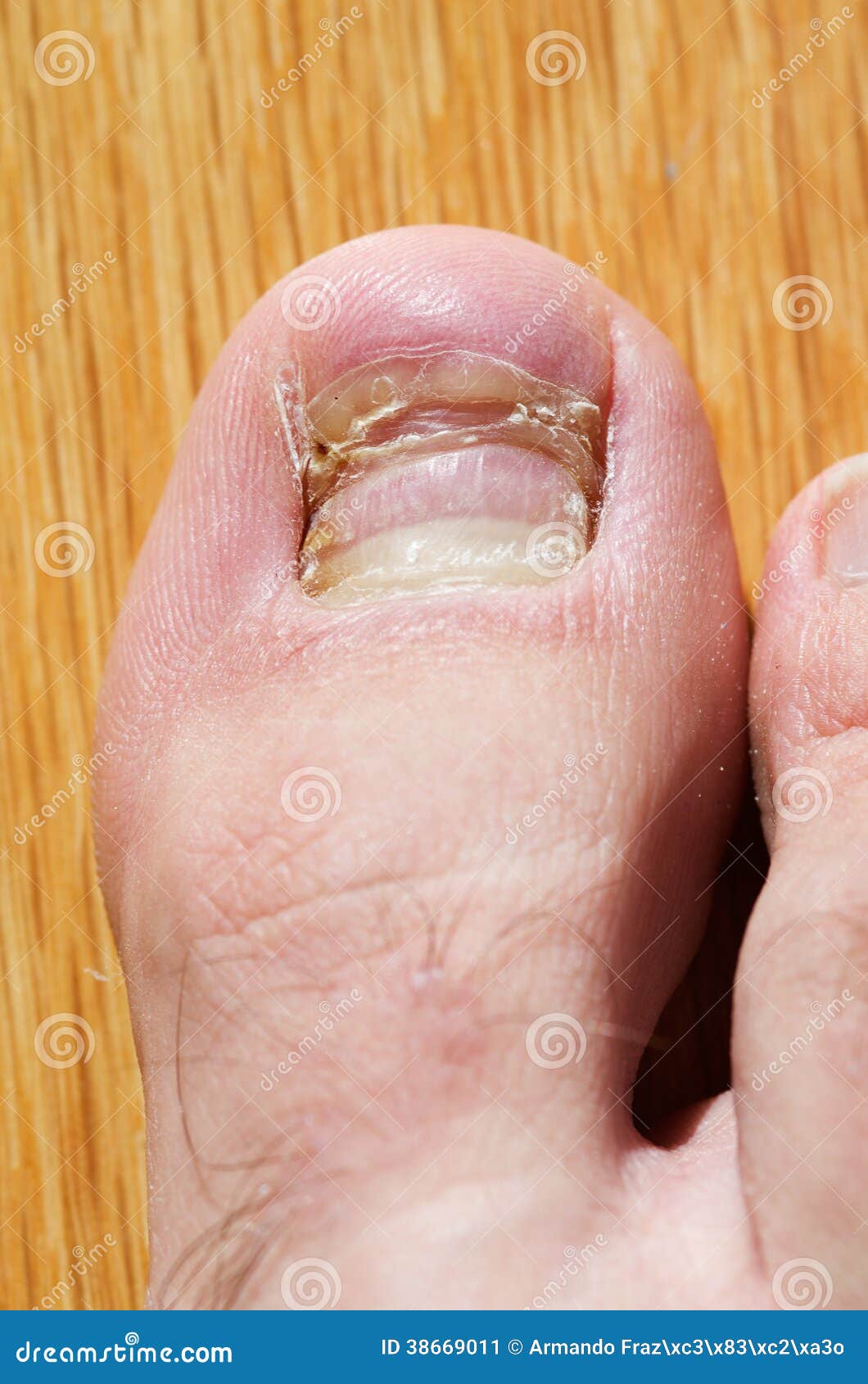 Toenail Growing Stock Photos - Free & Royalty-Free Stock Photos from  Dreamstime