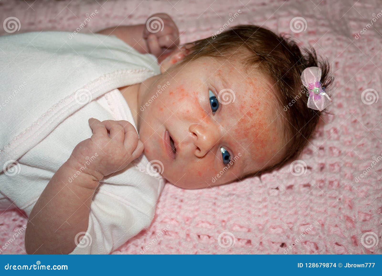 Newborn Baby With Severe Baby Acne Stock Photo Image Of Face