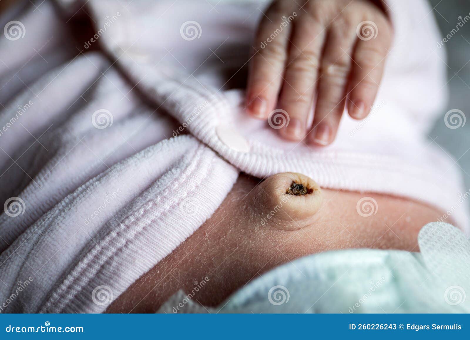 Newborn Hand and Navel with Umbilical Cord Just Fallen Off