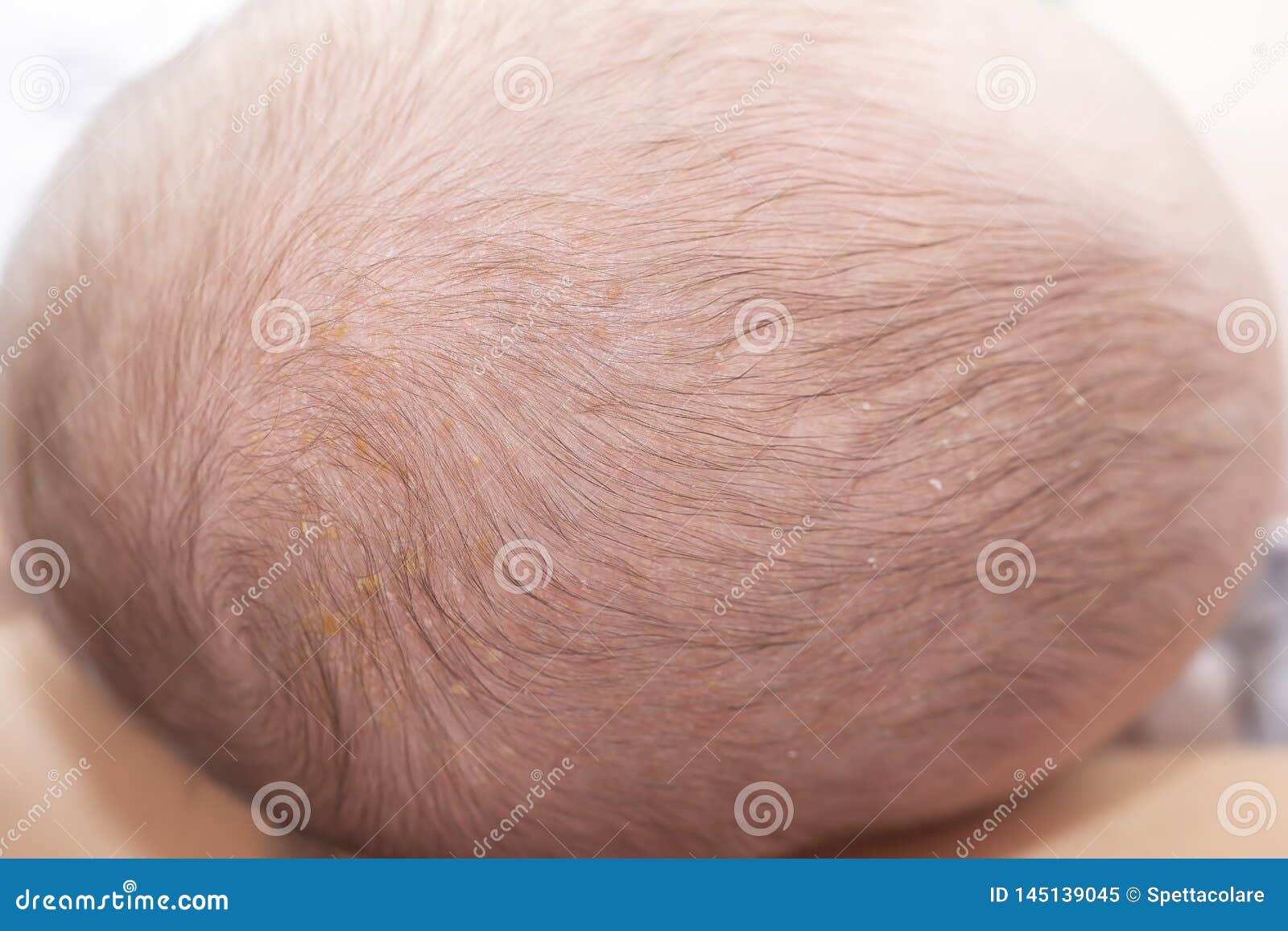 newborn head with cradle cap