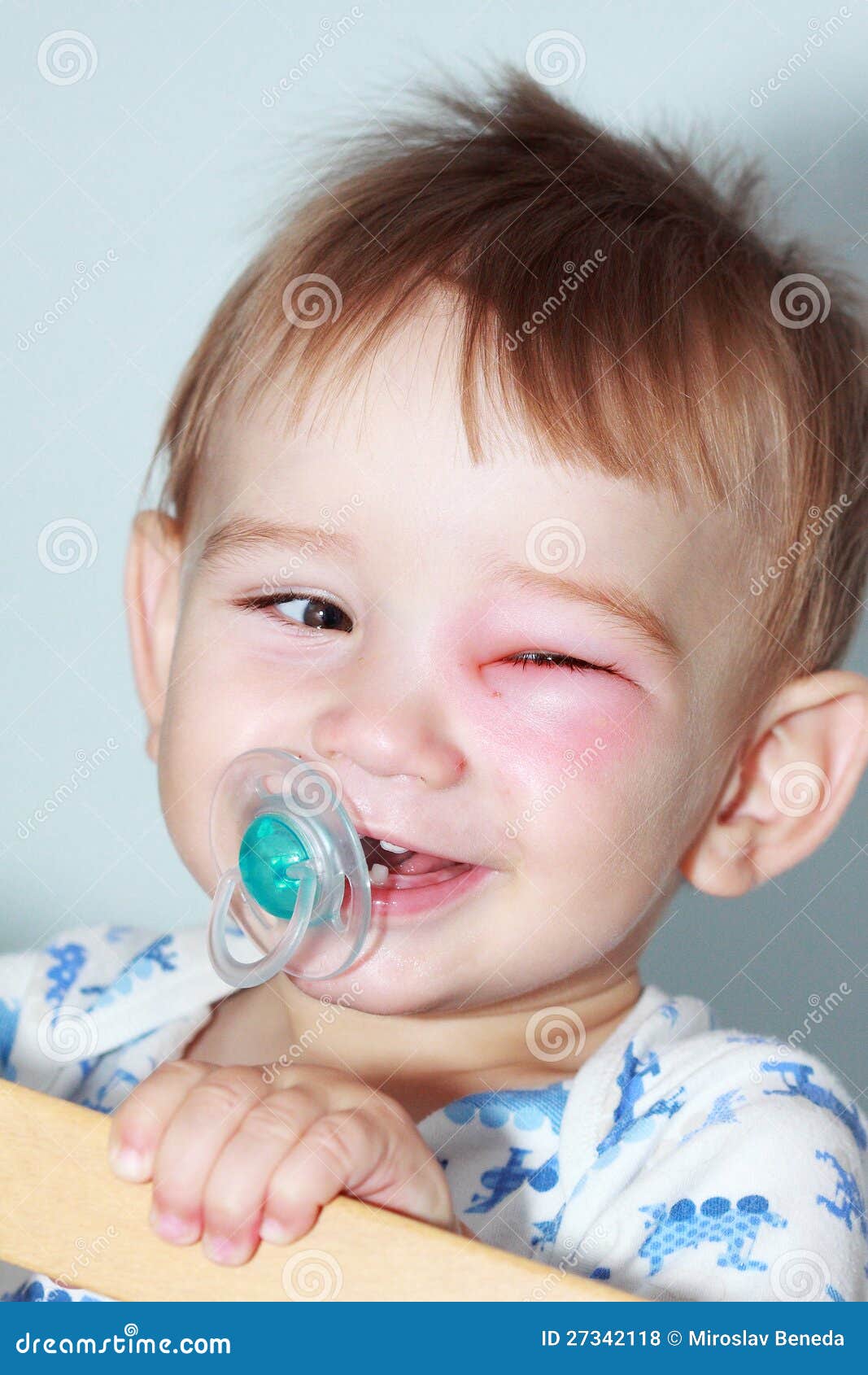 Newborn with red eye stock photo. Image of bacteria, medical 27342118