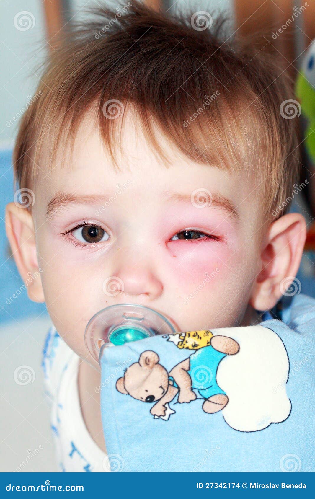 Newborn with red eye stock photo. Image of danger, injury 27342174