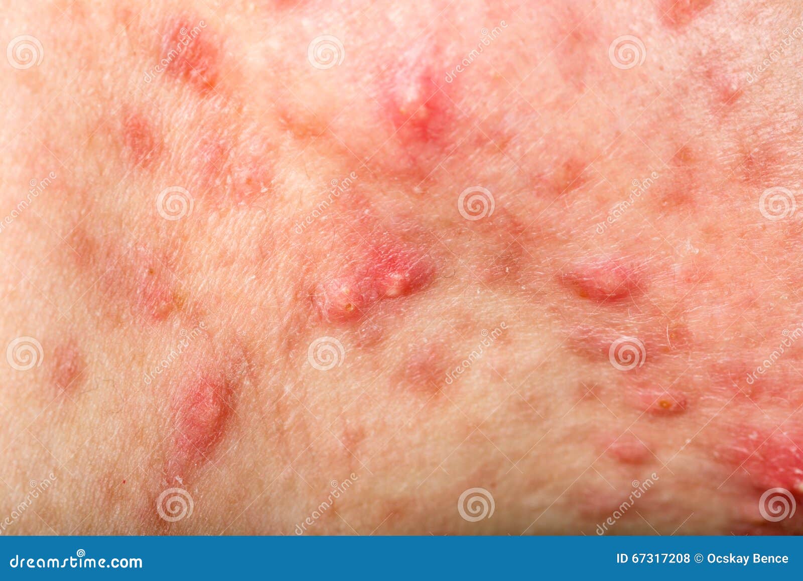 nodular cystic acne skin