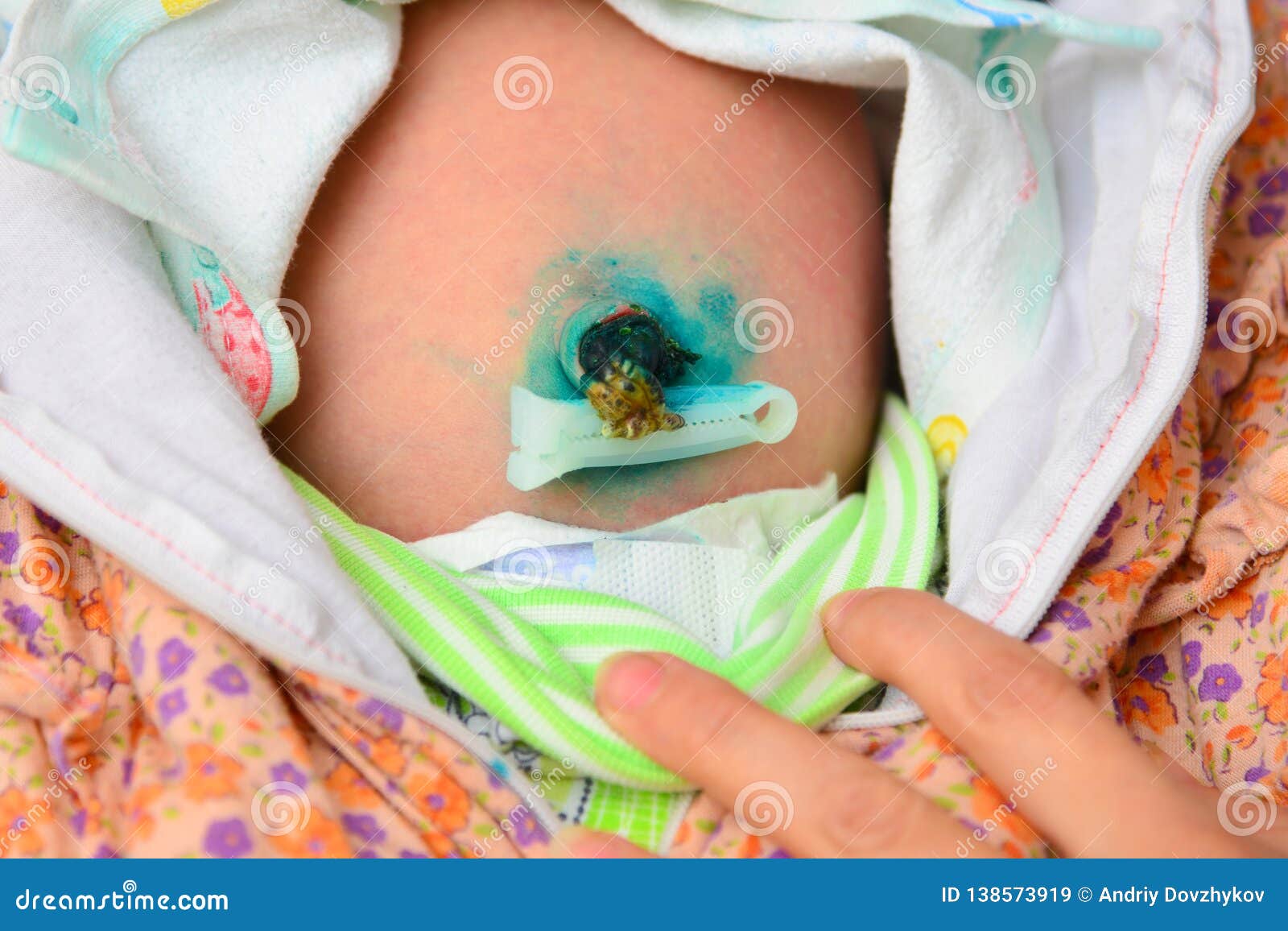 Nombril D Un Bebe Nouveau Ne Cordon Ombilical Traite Avec La Peinture Verte Image Stock Image Du Nombril Fuselage