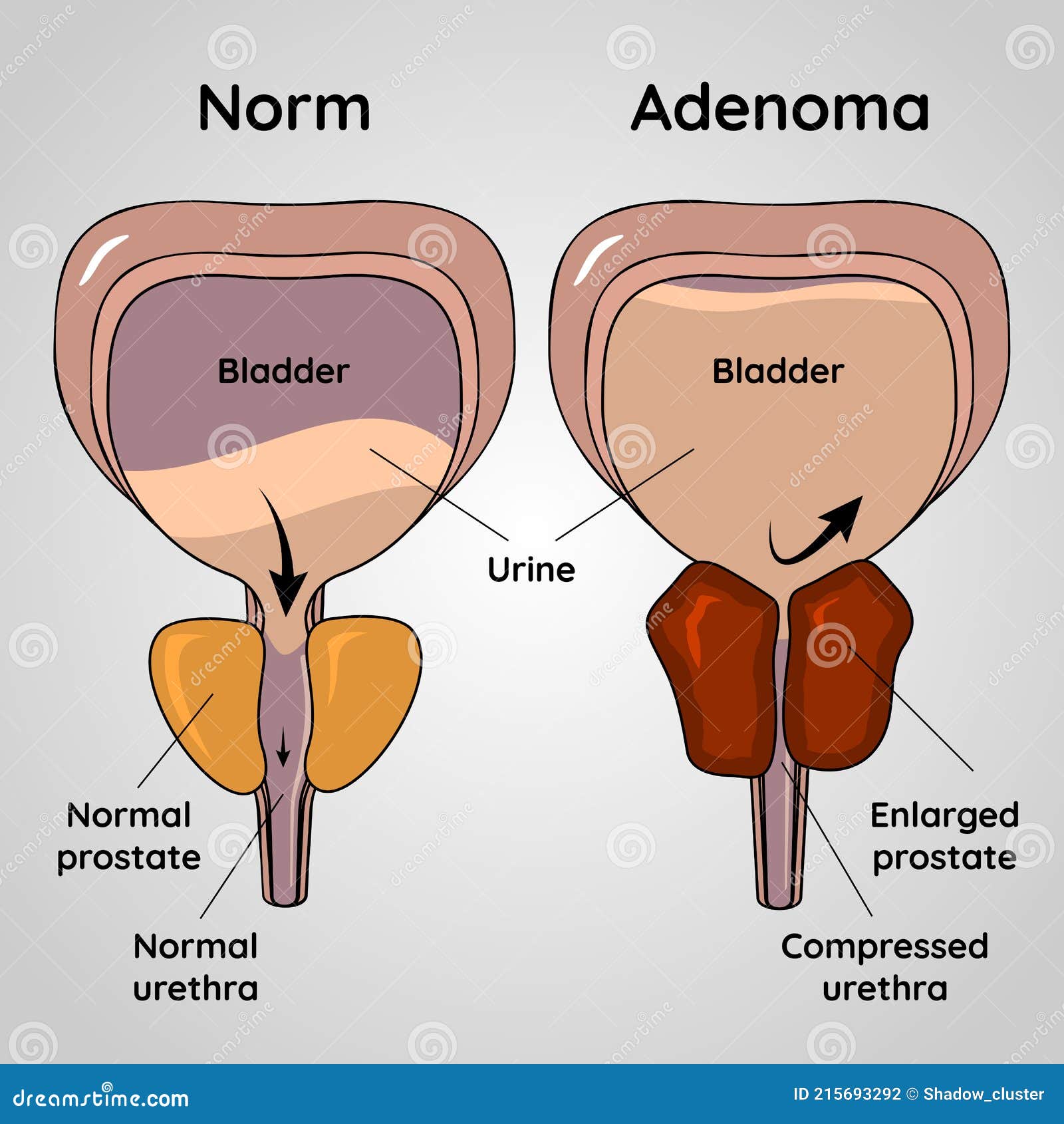 Embolizare adenom de prostata / Tratament adenom de prostata