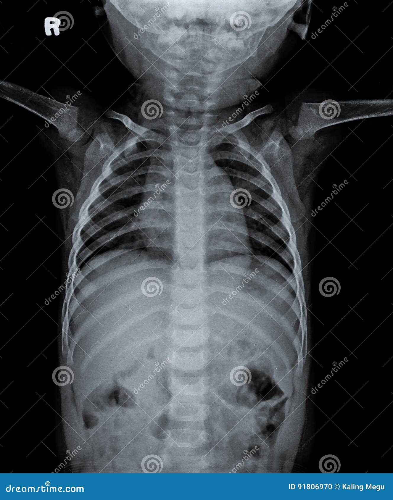 baby chest x ray device