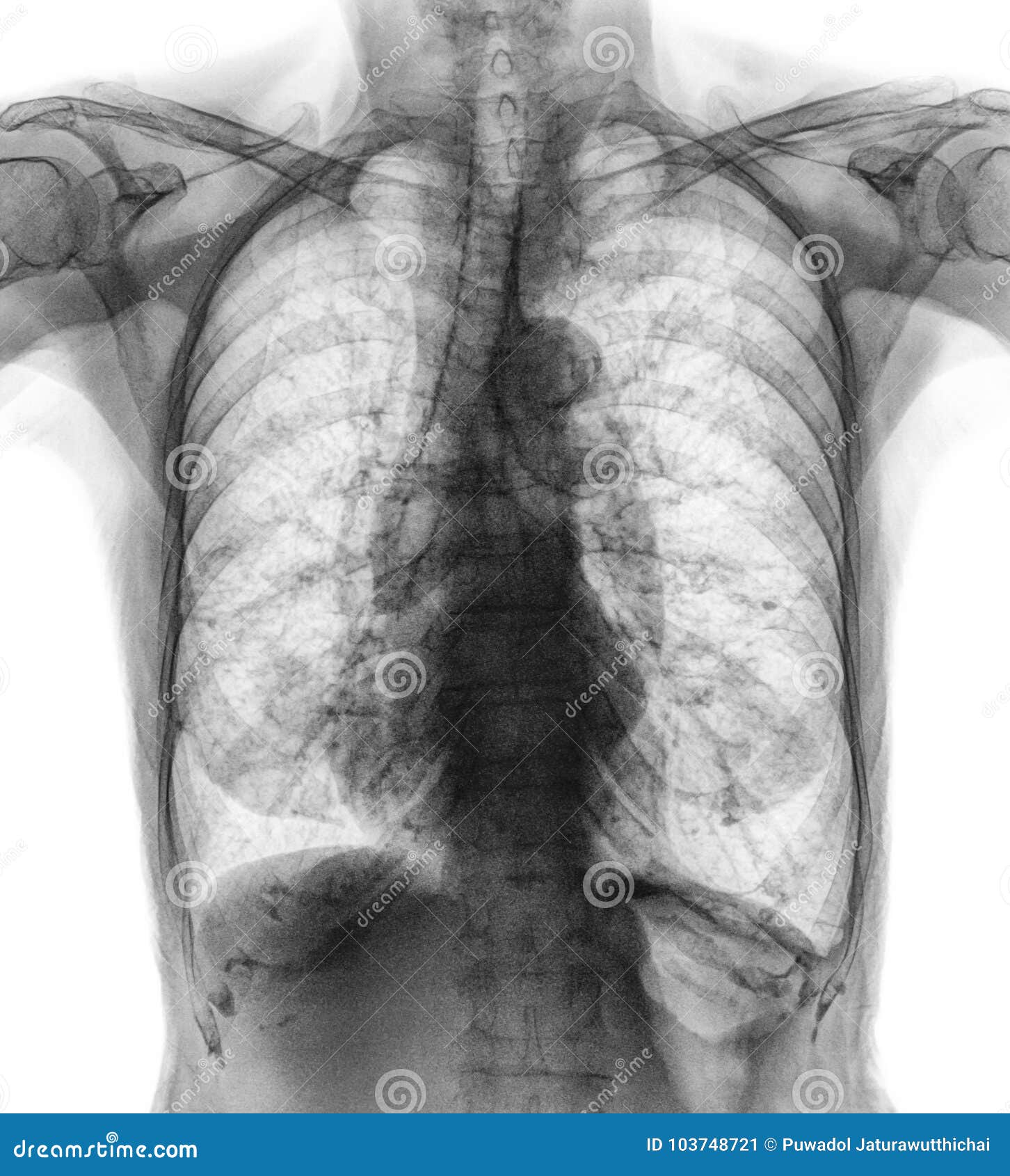 normal chest x-ray of old patient . you can seen calcification at rib , trachea , bronchus . front view