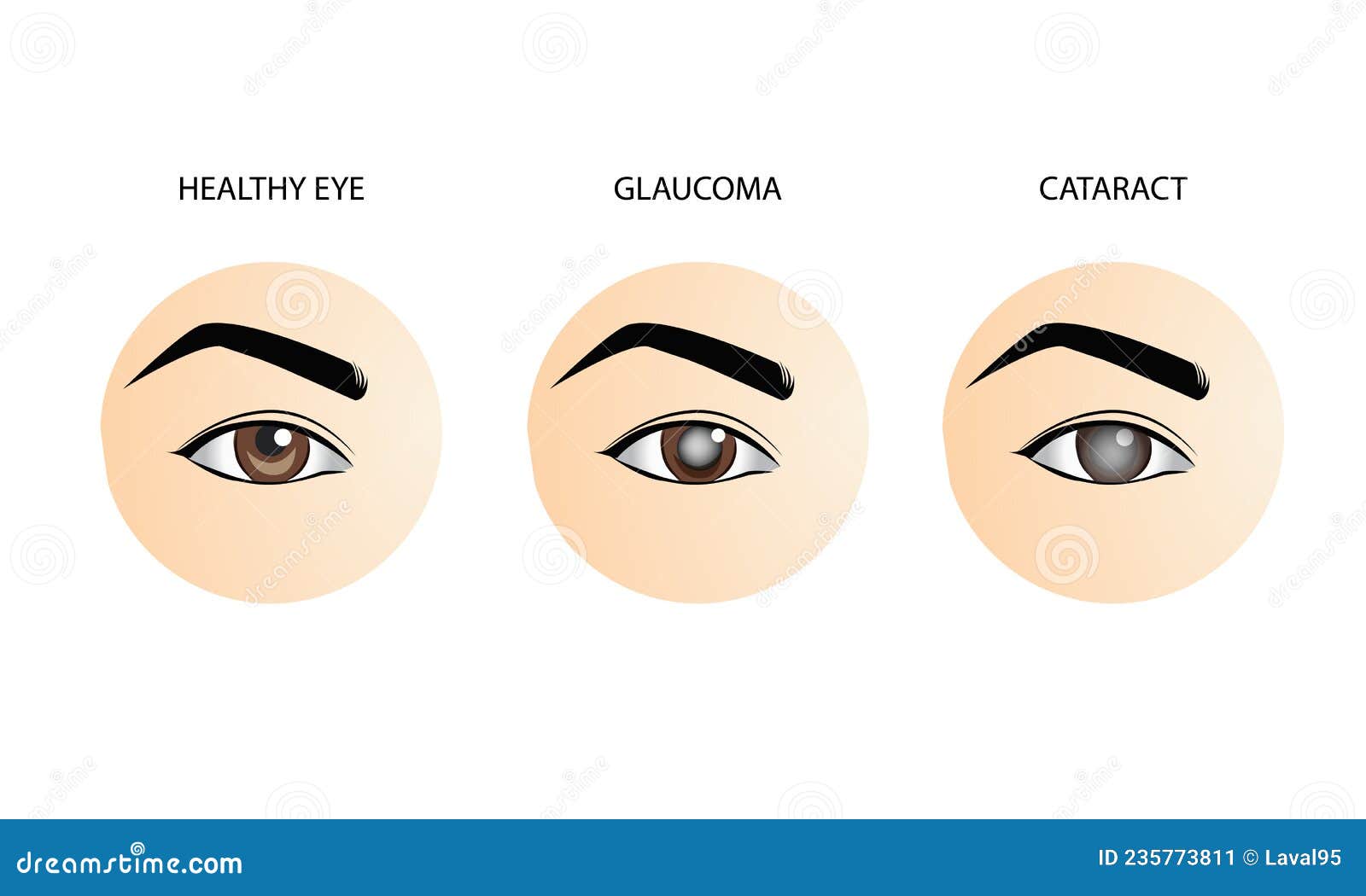 Normal Eye, and Cataract, Medical Vector Illustration Stock