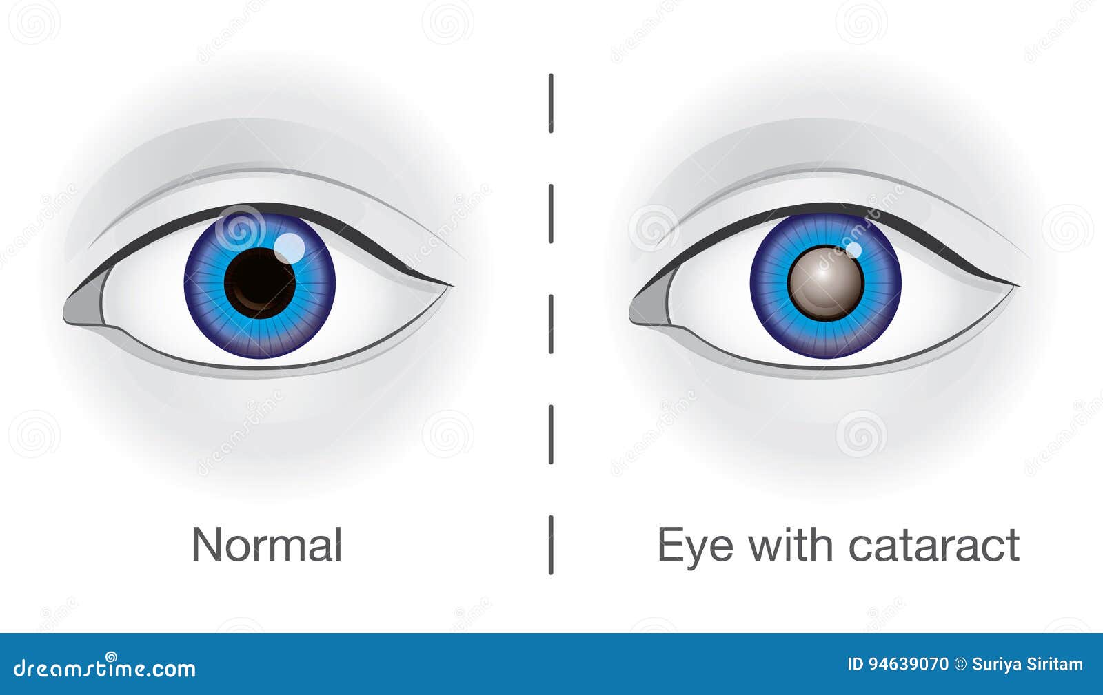 normal eye and lens clouded by cataract.