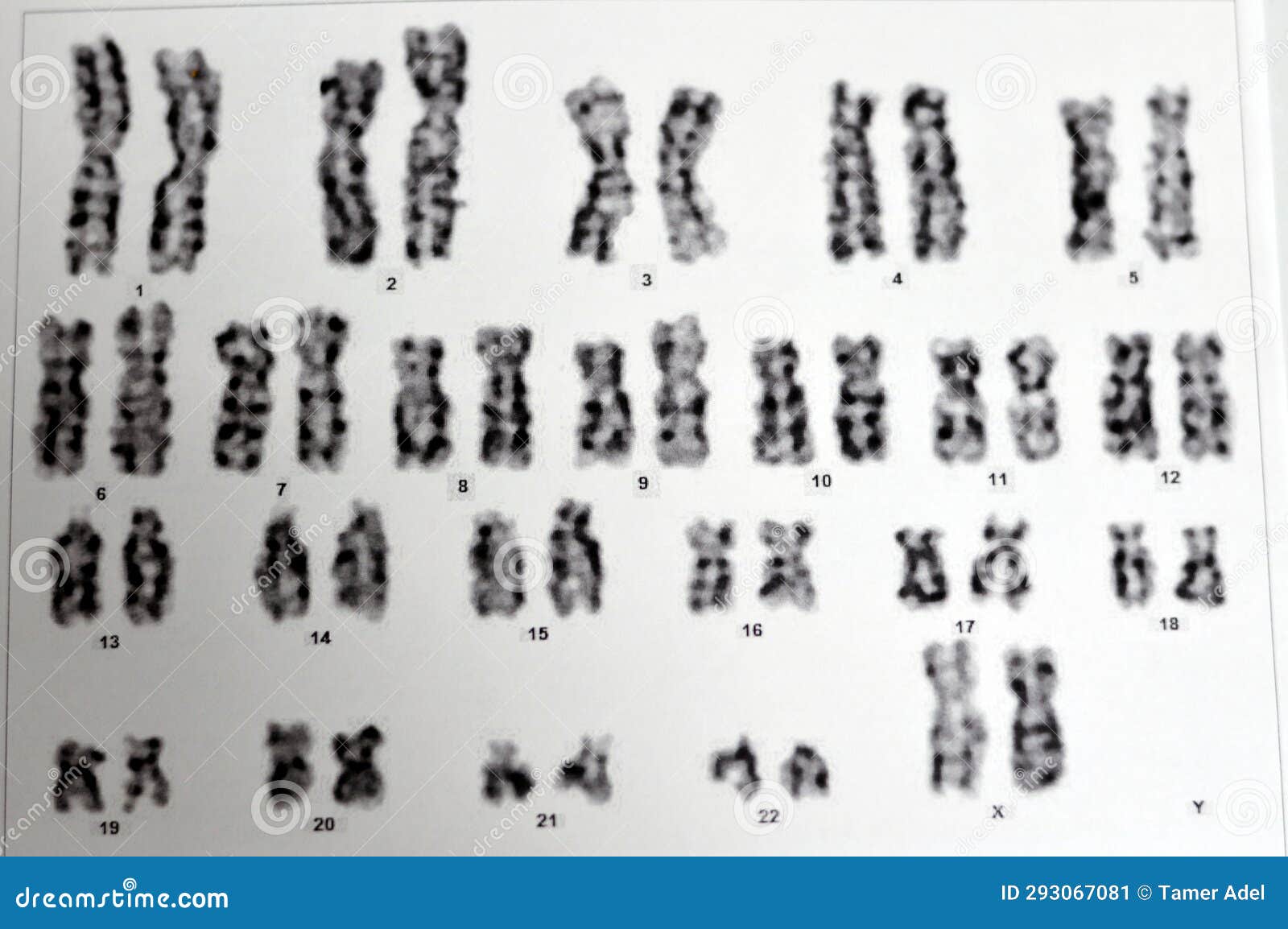 Normal Female Karyotyping 46 Xx Specimen Collected From Peripheral